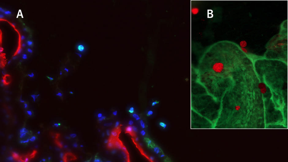 Neuartige Bildgebungstechnologie enthüllt die Rolle von Immunzellen bei der Entstehung des diabetischen Katarakts