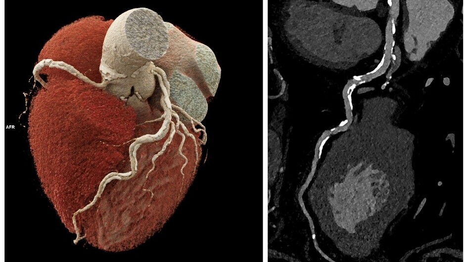 Erstmals nicht-invasive Diagnostik für Hochrisiko- Herzpatient*innen