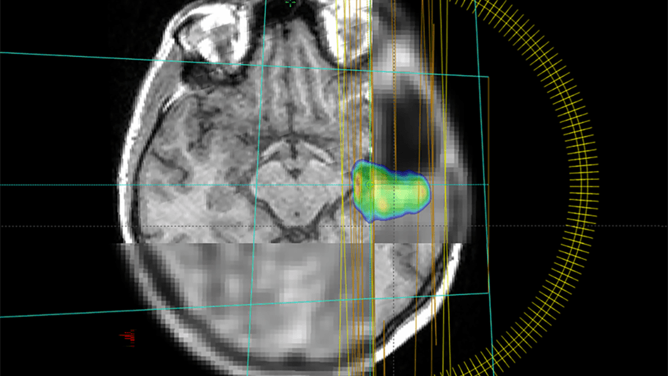 Aggressive Hirntumore dank innovativer Bildgebung und KI präzise bestrahlen