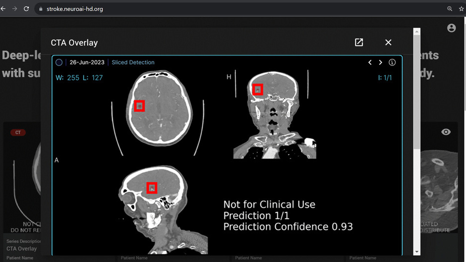 Schnellere und zuverlässigere Schlaganfalldiagnostik dank künstlicher Intelligenz