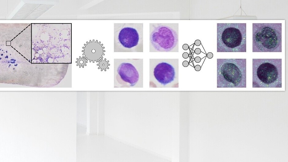 Leukämie: Künstliche Intelligenz unterstützt bei der Diagnostik