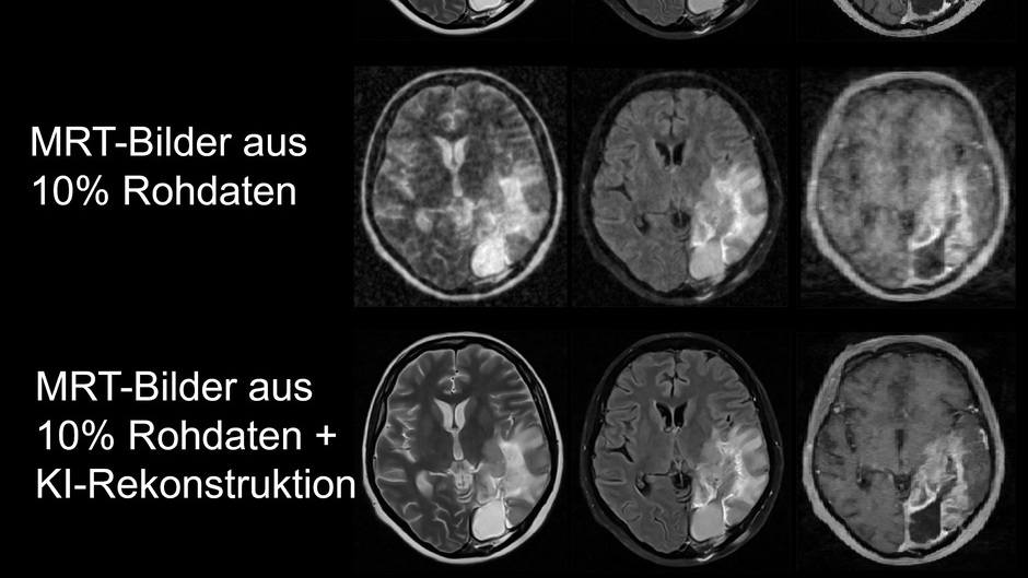 Mit künstlicher Intelligenz die Kernspin-Bildgebung beschleunigen