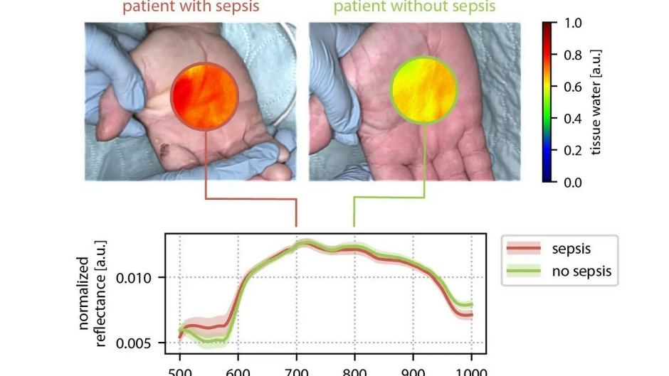 Schnellere Sepsis-Diagnose durch hyperspektrale Bildgebung und künstliche Intelligenz