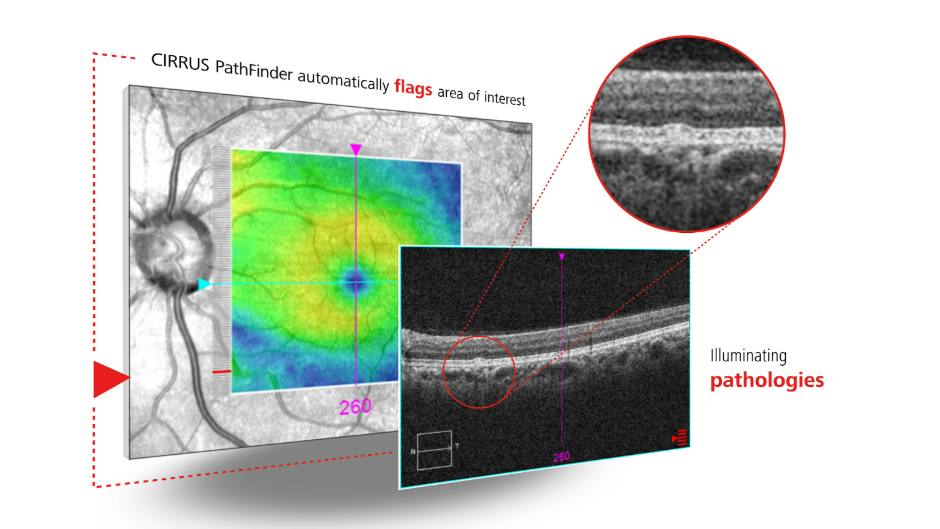 ZEISS erhält CE-Kennzeichnung für CIRRUS PathFinder für KI-unterstützte OCT-Auswertung