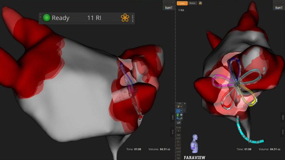 3D-navigierte Anwendung von Pulsed Field Ablation (PFA) bei Vorhofflimmern