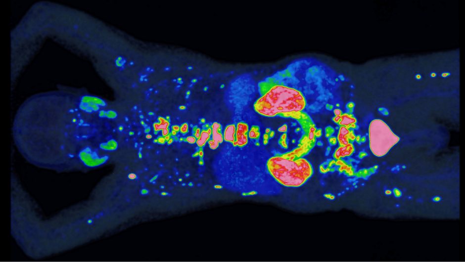 Neue PSMA-PET-Auswertung setzt internationalen Standard in der personalisierten Prostatakrebstherapie