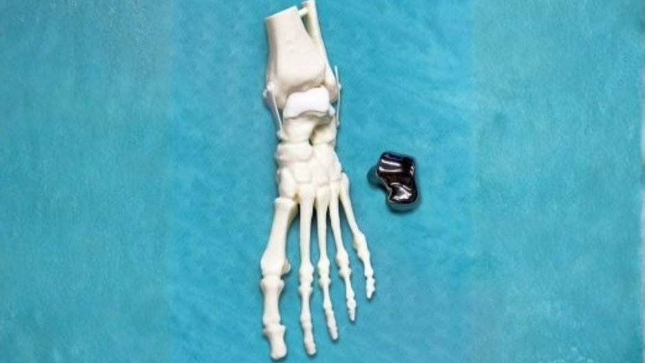 Komplettes Sprungbein erstmals per 3D-Druck ersetzt