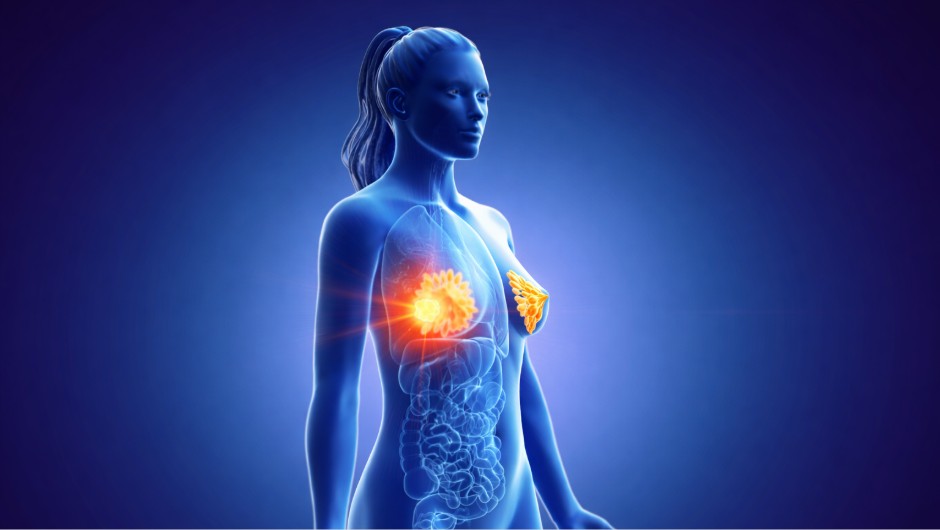 Evidenzbasierte Therapieentscheidung nach Mastektomie: Strahlentherapie bei moderatem Rückfallrisiko nicht erforderlich