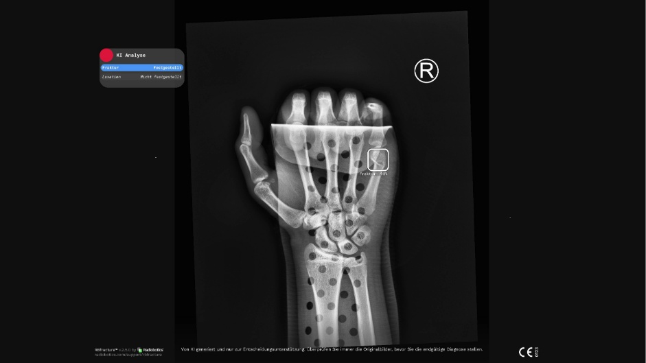 KI-gestützte Frakturerkennung beschleunigt Notfalldiagnostik in den Main-Kinzig-Kliniken