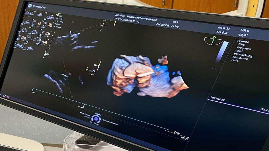 Modernste 3D-Echokardiografie am Klinikum Darmstadt eingeführt