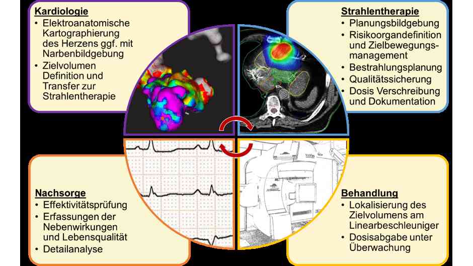 Strahlentherapie eröffnet neue Option bei schweren Herzrhythmusstörungen