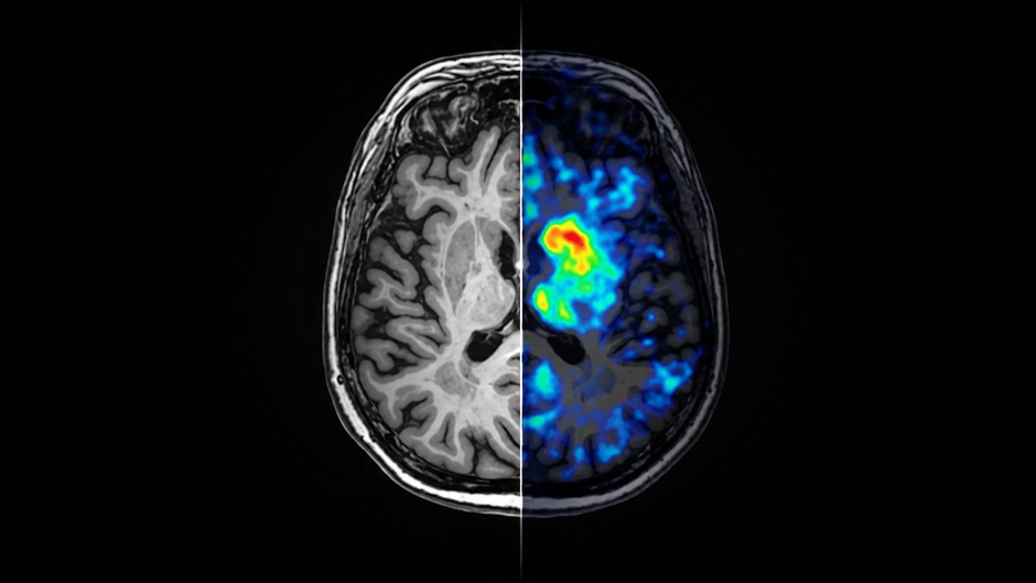 Neuer PET-Tracer macht Parkinson-Prozesse erstmals im lebenden Gehirn sichtbar