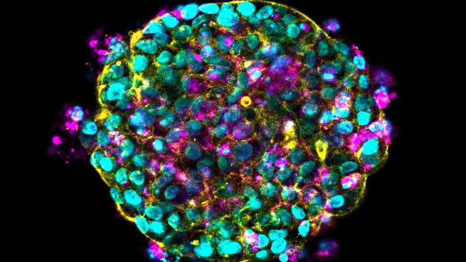 3D-Minitumoren zeigen neuen Ansatz zur Bekämpfung therapieresistenter Brustkrebszellen